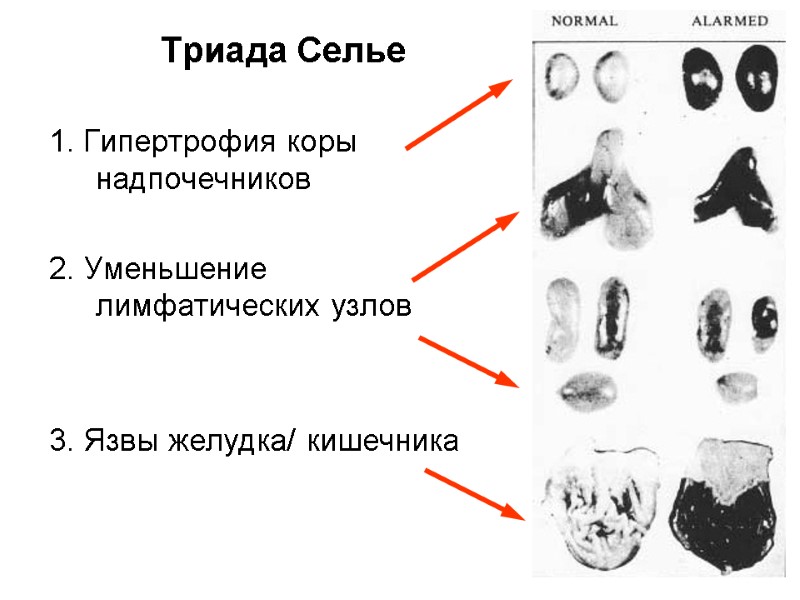 Триада Селье 1. Гипертрофия коры надпочечников  2. Уменьшение лимфатических узлов   3.